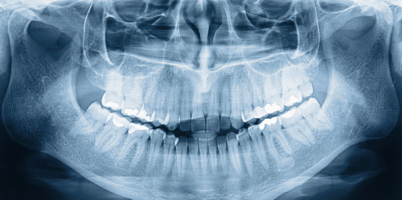 A panoramic x-ray was taken by a certified dental assistant that received their x-ray license from DANB. Dental assisting.
