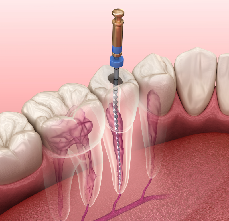 Endodontic assistant. Endodontics. Dental assisting. Dental assistant. Dental assisting school